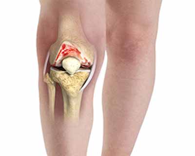 Surgical Management of Osteoarthritis of the Knee- AAOS  Guideline 2016