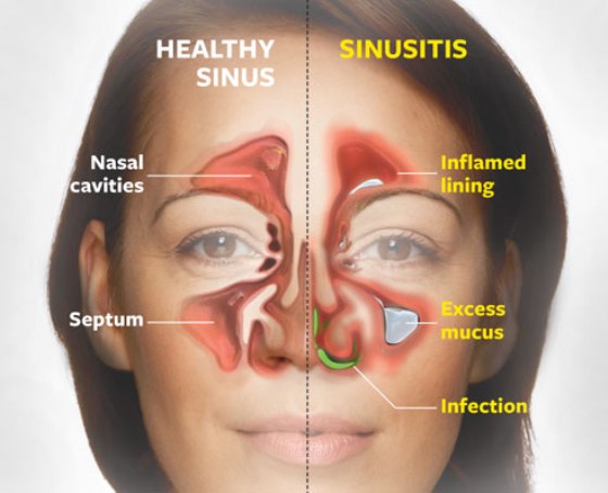 Study finds no role of antibiotics in uncomplicated sinusitis in adults