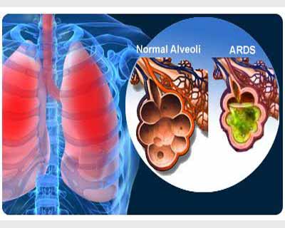 Corticosteroids in ARDS : A study on children