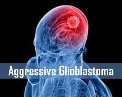 Scientists have discovered what makes Glioblastoma Cancer aggressive