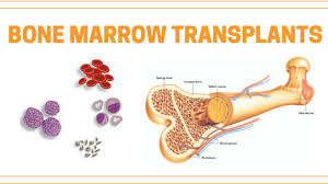 Doctors create MAGIC algorithm to predict bone marrow transplant patients risk of dying