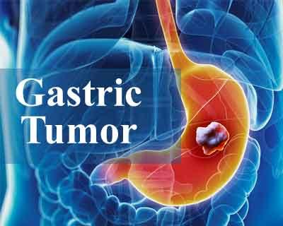 Mouse Studies show promise for Aggressive Gastric Tumor treatment