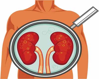 Obese young adults at high risk of kidney disease