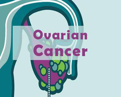 New test to predict exact time ovarian cancer patient would live