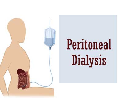 Wearable artificial kidney convenient method of dialysis for CKD patients