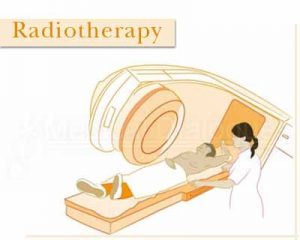 Radiotherapy for Lung Cancer can be dangerous: Study