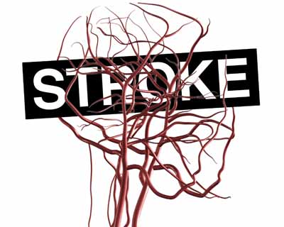 In Patient Rehab Recommended Over Nursing Homes for Stroke Rehab