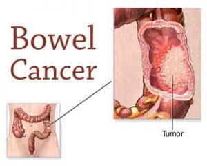 A new genetic weapon in fight against bowel cancer