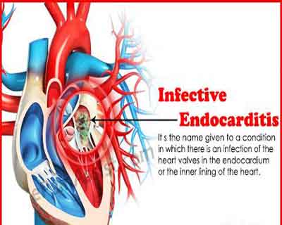 Cardiology Update: Infective Endocarditis- Surgical intervention or medical management??