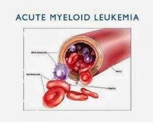 Novel drug may triple the survival rate in acute myeloid leukemia