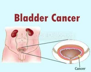 New Drug Found Effective Against Aggressive Bladder Cancer