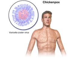 Google Search reveals impact of chickenpox shots