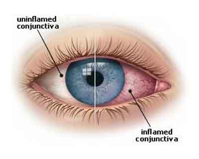 Do not ignore redness, swelling of eyes during monsoon: Health experts