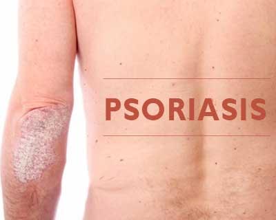 Largest psoriasis meta-analysis to date yields new genetic clues