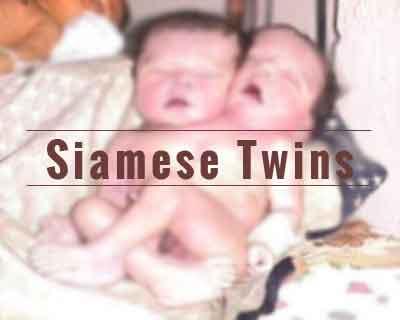 Maharashtra: Siamese twins born in latur, die on their way to tertiary care centre