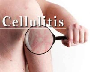 70% skin breaks in diabetics can turn into cellulitis, say doctors