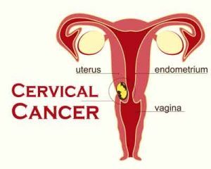 Continue cervical cancer screening even beyond 65 years, says new Study