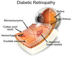 Choroid layer thickness significantly in untreated Diabetics  : Study