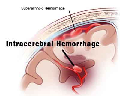 Restarting antiplatelet therapy SAFE after intracerebral hemorrhage: ERICH study