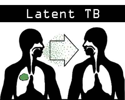 MBBS, nursing students at higher risk of developing latent TB: CMC Vellore Study