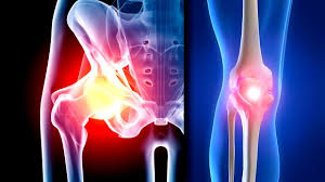 AAOS approves diagnostic and treatment criteria for osteoarthritis of the hip