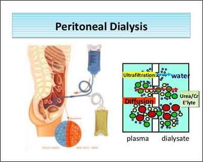 New treatment approaches to improve peritoneal dialysis