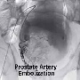 Prostatic artery embolisation easier way to cure prostate enlargement: Experts