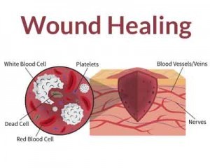 Lasers can help monitor burn wound healing