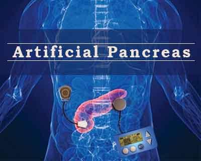 Artificial pancreas likely to be available by 2018