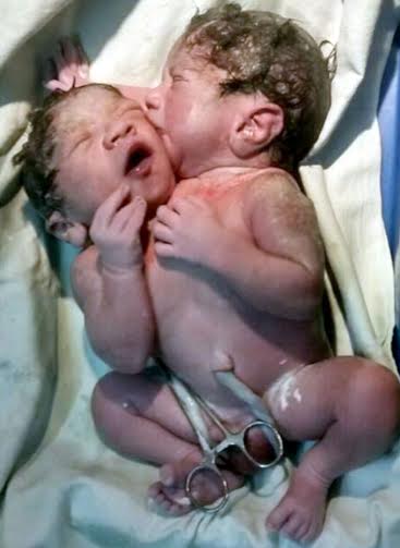 Rare Conjoined Twins Born In Mumbai Hospital