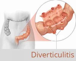 Which patients of diverticulitis require Surgery?