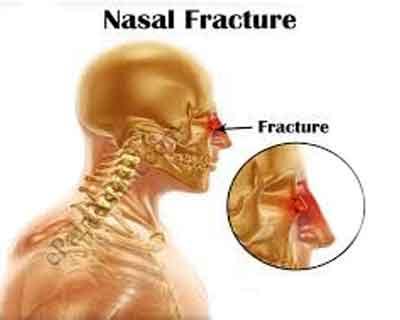 Nasal fracture most common injury during vehicle collisions