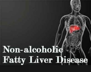 A new index for the diagnosis of non-alcoholic fatty liver disease
