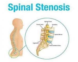 New Delhi : Man cured of Lumbar Spinal Stenosis through Micro decompression Laminaplasty
