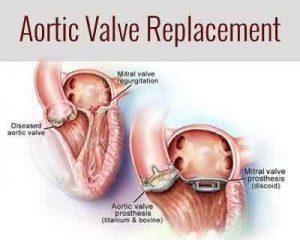 Outcomes of TAVR Performed for Off-Label Indications : JAMA Study