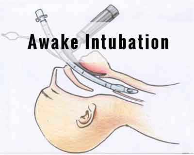 High success, less complications with Awake Intubation : Study