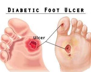 Topical gentamicin-collagen sponge safe, well tolerated in diabetic foot ulcers