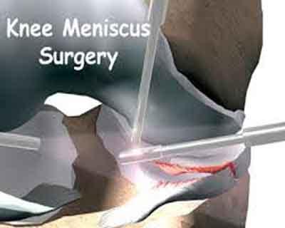 Intraoperative Platelet-rich plasma reduces meniscus repair failure risk, finds study