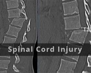 Nanoparticles limit damage in spinal cord injury