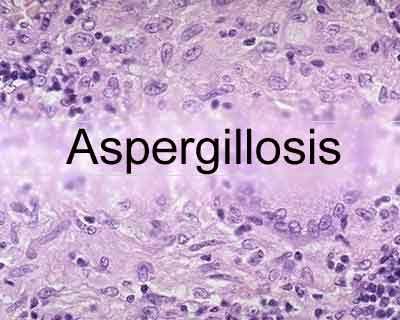New test could screen patients at risk of Aspergillosis