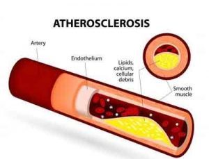 Higher thyroid hormone levels associated with atherosclerosis and early death