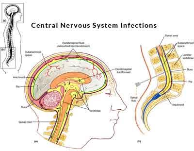 Multiple sclerosis: Cholesterol crystals prevent regeneration in central nervous system