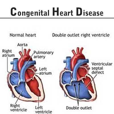 congenital heart disease