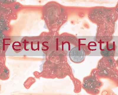 Tamil Nadu: 3.5 kg fetus removed from infants stomach in rare fetus in fetu surgery