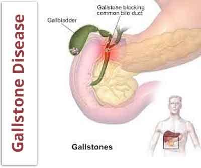 Gallstone disease may increase heart disease risk : AHA Study