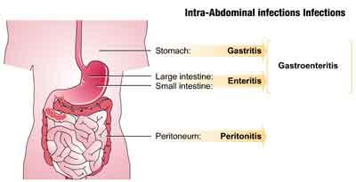 Beta-lactams effective alternative for intra-abdominal infections