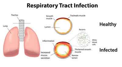 Reduced kidney function ups risk of respiratory tract infections