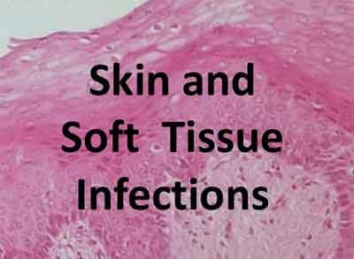 Management of skin and soft-tissue infections: 2018 WSES/SIS-E consensus statement