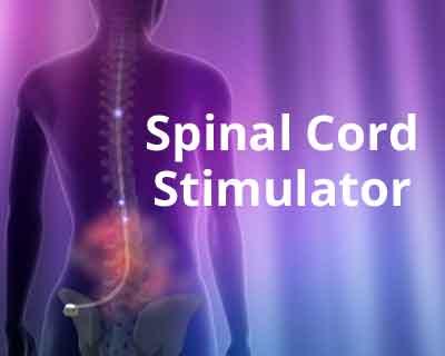 New Delhi: Spinal cord stimulator cures woman of lumbar spine disc disease