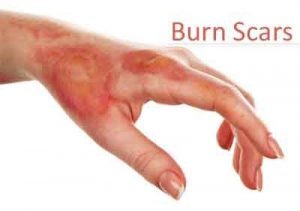 Vitamin D can help burns to heal and prevent scarring